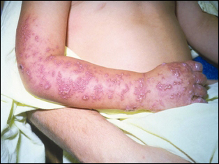 Shingles is uncommon in infants, and likely to be a result of a primary infection of varicella zoster virus in utero.