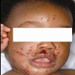 The only abnormal finding was the generalized eczema and the rash on his face and neck as shown in Figures 1-3.