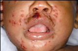 The only abnormal finding was the generalized eczema and the rash on his face and neck as shown in Figures 1-3.