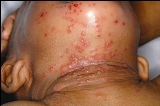 The only abnormal finding was the generalized eczema and the rash on his face and neck as shown in Figures 1-3.