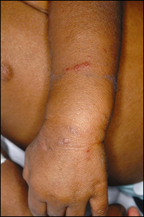 The patient also had widely scattered lesions on his extremities.