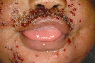 The lesions of eczema herpeticum begin to crust over after treatment with IV acyclovir.