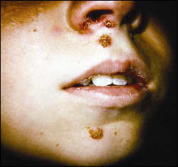 Impetigo lesions are usually usual honey-colored and crusted.