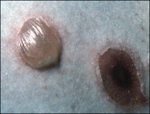 Bulbous impetigo (infected with S. aureus).