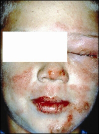 Poison ivy exposure on the face is often confused with cellulitis.