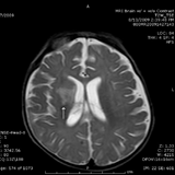 Figure 2: Child's cough persisted for more than 30 seconds