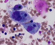 Figure 5: Severe pulmonary infiltrative disease and mandibular destruction.