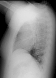 Figure 4: A plain chest radiograph showing normal results.