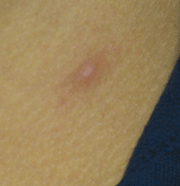 Figure 6: Two weeks after treatment with azithromycin. The mass was not palpable and the lesion is gone.