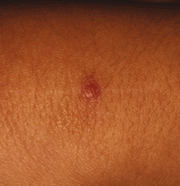 Fig 7: A cutaneous granuloma may not always be seen, but here is visible in the healing scratch.