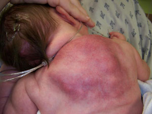 Figure 1: Erythematous, tender, raised, firm rash was noticed