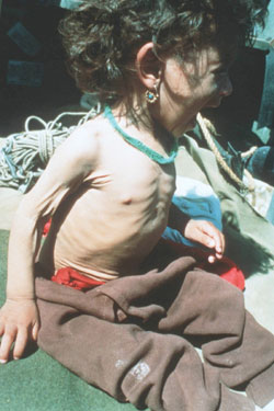 Figure 12: A toddler from the refugee camp who suffered from chronic diarrhea.