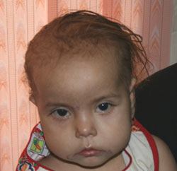 Figure 1: Child with "moon face," thinning hair and apathetic facial affect.