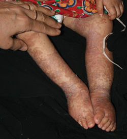 Figure 2: Eczematous skin with ulcerations and flaky appearance.