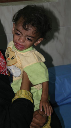 Figure 6: One of the many malnourished infants who were treated at the rehabilitation center.