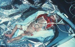 Figure 4: Patient with septic shock and pneumonia.