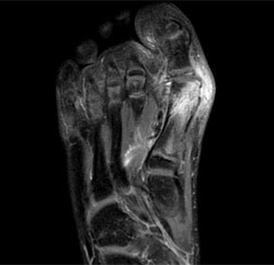 Figure 1. MRI of the foot showing osteomyelitis of the first metatarsal.