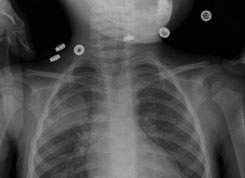 X-ray from 2 weeks prior shows lobar pneumonia.