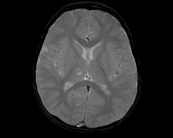 Serial MRIs revealed almost complete resolution of even the largest of the abscesses.