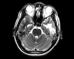 Image shows a complicated ear infection with mastoiditis, most likely associated. P. aeruginosa. 