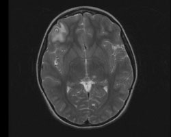 T. solium is the pork tapeworm and the cause of neurocysticercosis, which can result in similar-appearing brain lesions when embryonated ova are ingested.