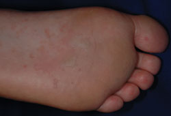 Figure 5: A few days after beginning treatment.