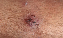 Figure 10: Soft tissue MRSA infections can take different forms, including a focal infection seen in this photo.