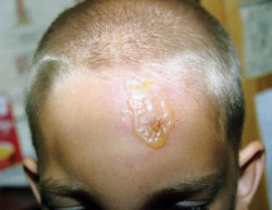 Figure 3: Herpes with secondary Staphylococcus aureus infection.