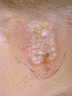 Figure 4: Herpes with secondary Staphylococcus aureus infection.