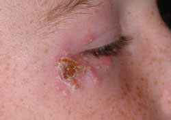 Figure 5: A few days after beginning treatment.