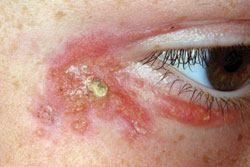 Figure 6: About 1 month after treatment initiation.