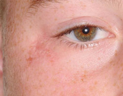 Figure 7: About 2 months after the end of therapy, showing near normalization of the area, with only minor scarring.