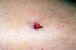 Figure 8: A chronic sore caused by Mycobacterium marinum, which can closely resemble sporotrichosis.