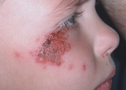 Figure 9: Cutaneous herpes simplex or zoster.