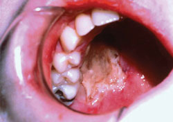 Figure 10: These photos are of an adolescent with chronic diabetic ketoacidosis (DKA). showing the inflammation and tissue destruction in the palate.