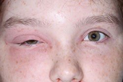 Figure 1: The patient has painful swelling and erythema of the area around her right eye and marked swelling with severe pain over the forehead.