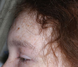 Figure 2: The patient has painful swelling and erythema of the area around her right eye and marked swelling with severe pain over the forehead.