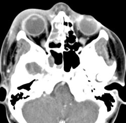 Figure 3: A computed tomography scan on admission.