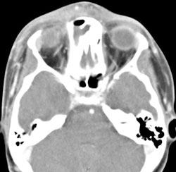 Figure 4: A computed tomography scan on admission.