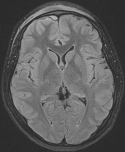 Figure 5: Magnetic resonance imaging on the same day is shown in (representative T2 images)