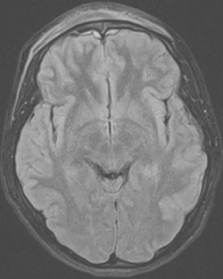 Figure 6: Magnetic resonance imaging on the same day is shown in (representative T2 images)