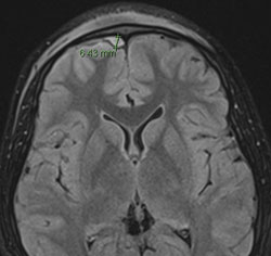 Figure 7: The T2-weighted MRI images revealed the small, bilateral frontal lobe abscesses.