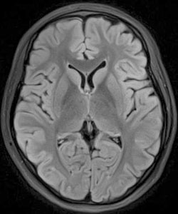 Figure 8: A repeat MRI showed complete resolution of the frontal abscesses.