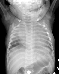 Figure 2: Evidence of pulmonary TB of the right upper lobe.