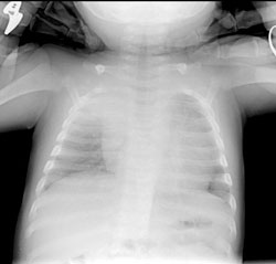 Figure 3: The patient's chest radiograph 1 month into therapy was somewhat improved.