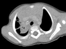 Figure 4: After 2 months, a chest radiograph revealed worsening right upper lobe infiltrate and he underwent a CT scan.