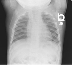 Figure 6: After anti-TB therapy and steroid therapy with a 3-week taper, good results were produced.