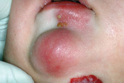 Figure 1: The only positive findings were the lesion on his lower lip and chin and a hemangioma on the lower part of the chin, well away from the area of erythema.