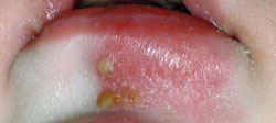 Figure 2: The chin was red and swollen and there were some discrete pustular lesions just below the lower lip.