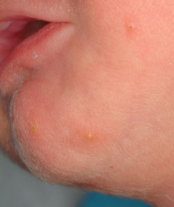 Figure 6: Erythema toxicum is a common, benign skin condition of newborns, but a bit unusual at this age and produce smaller pustules.